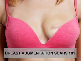 Image result for Breast Augmentation