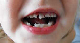 Traumatismos Dentales En Ninos Dentista Jm Arizala