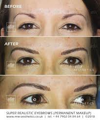 Reset room before after photos of picosure laser tattoo. Semi Permanent Eyebrows Mw Aesthetics