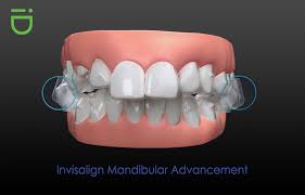 In order to correct an overbite, you will need to work closely with an orthodontist, a doctor who specializes in dentistry. Explaining The Purpose Of Mandibular Advancement To Correct Smiles