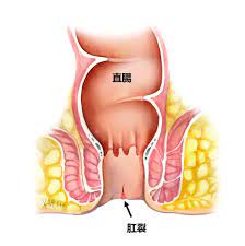 肛裂| 悉尼大腸外科醫生