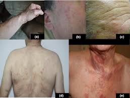 My skin is really thin and splits easily. Folliculotropic T Cell Infiltrates Associated With B Cell Chronic Lymphocytic Leukaemia Or Malt Lymphoma May Reveal Either True Mycosis Fungoides Or Pseudolymphomatous Reaction Seven Cases And Review Of The Literature Ingen Housz Oro 2015