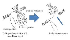 Image result for Hernia Reduction