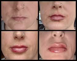 Does juvederm last longer than restylane? My First Experience With Lip Fillers 1 Ml Of Restylane Defyne And Holy Swelling Batman Top Left Is Before Top Right Is Immediately After Bottom Left Is 5 Hrs Later Bottom Right
