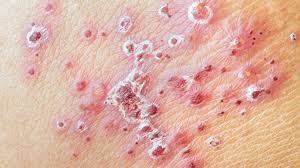 Image result for genital herpes