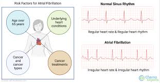 Image result for Atrial Fibrillation