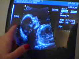 This scan should be ideally performed between 12 weeks 5 days and 13 weeks 6 days of your pregnancy. Dating Scan Babycenter Canada