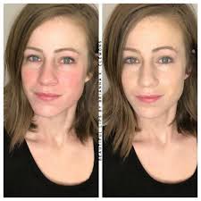 best product to get rid of redness??