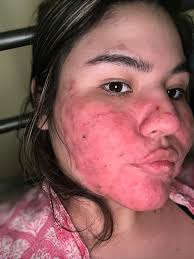 Cleanser helping with hidradenitis suppurativa symptoms