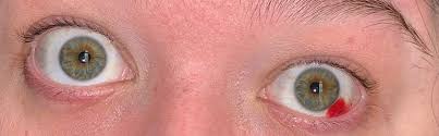 Have you ever looked at someone else and thought, hey, their eyes are really pretty? Eye Cancer I Have Some Light Spots On British Liver Trust
