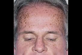 Vitiligo may also occur at your hair roots and turn your hair gray or white. Picture Of Vitiligo Hair On Medicinenet