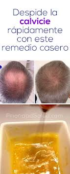 Diles Adios A La Calvicie Alopecia Caida Del Cabello Y La Caspa Con Este Tratamiento Casero Hair Growth Tips Alopecia Hair Hacks