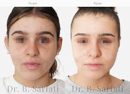 Heureusement, il existe une intervention relativement simple qui permet de corriger des oreilles. Otoplastie Oreilles Decollees A Paris Et Neuilly Dr B Sarfati