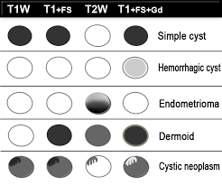 The Radiology Assistant Ovarian Cysts Diagnostic Work