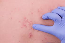 Capsulas De Salud Culebrilla O Herpes Zoster Nexum International