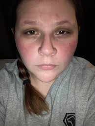 Does anyone else's cheeks get super red? It calmed down since I showered  but work causes my cheeks to become so red. Wondering if it's a Chiari or  pseudo tumor thing? And