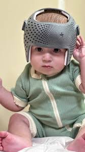 كيف يتم تحديد الحاجة إلى الخوذة لتعديل شكل الرأس؟