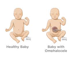 Learn about what to expect at 10 weeks with babycenter. Omphalocele Diagnosis Treatment Ssm Health
