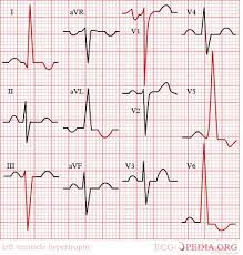 For the first two thirds of the cohort, ecgs were analyzed manually, whereas after exclusion of all of the patients presenting lvh by the sokolov criteria, 569 patients were left for. Left Ventricular Hypertrophy Electrocardiogram Wikidoc