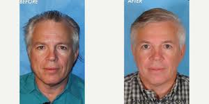 Alan Bauman, MD, Board Certified Hair Restoration Surgeon