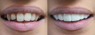 All in all, i do think it's pretty incredible that clip on veneers can instantly transform a crooked smile and even cover gaps where a missing tooth may have once lived, but it's probably best to. Press On Veneers The Dental Guide
