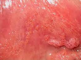 عکس وستیبولار پاپیلوماتوز + عکس پاپول مرواریدی زنانه