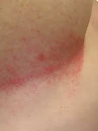 Image result for heat rash under breasts