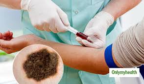 Cancer is the ultimate killer: A Blood Test Might Detect Melanoma Skin Cancer Study