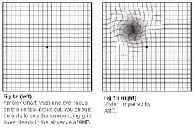 Age Related Macular Degeneration