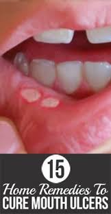 Biting The Inside Of Your Cheek Treatment At Home Remedies For Canker Sores In The Mouth Natural Treatments Ulcer Remedies Mouth Mouth Ulcers Mouth Sores