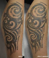 How many tattoo removal treatments are needed to get rid of the tattoo completely? Leg Tattoo After 2 Sessions Lasertattooremoval Tattooremovaltoronto Tattoo Howtoremoveatattoo Tribal Tattoos Tattoo Removal Tattoos