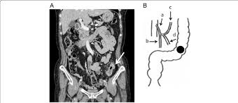 Due to the rising incidence of colorectal cancer in younger people, the american cancer society also recommends that people at average risk of it is important to note that, regardless of the screening test and schedule, any test that indicates an abnormality should be followed up with a colonoscopy. A The Abdominal Ct Scan Showed T3 Colon Cancer Near The Sd Junction Download Scientific Diagram