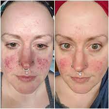 What is ivermectin dosage for human. B A Rosacea Progress 36 Days Of Ivermectin 2 Wks Doxycycline 1 Week Azelaic Skincareaddiction