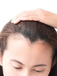 This kind of hair loss can also lead to thinning of. How To Stop And Regrow A Receding Hairline Best Treatments Allure