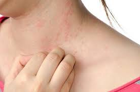 Image result for contact dermatitis