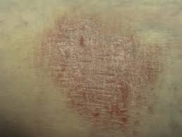 Image result for Lichen Simplex Chronicus