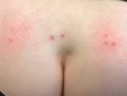 The low temperatures will create a numbing effect on the bitten area overall, the pack helps reduce the burning sensation associated with ant bites. Ant Bites And Stings Dermnet Nz