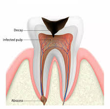 Oral abscess: Causes and treatment | CURAPROX