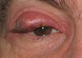 See full list on wikihow.com Chalazion Symptoms Pictures Causes And Treatment