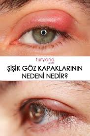 Sisik Goz Kapaklarinin Nedeni Nedir Saglik Gozler Kadin