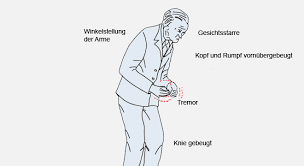 Alkohol sei gut gegen essentiellen tremor. Parkinson