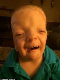 Boy, six, who was born severely disabled has a condition so rare it has  been named after HIM
