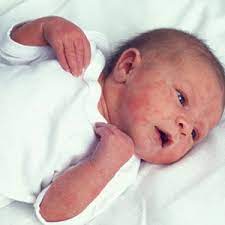 Beras merah juga mengandung zat besi merupakan mineral yang sangat dibutuhkaan oleh pertumbuhan bayi dan anak. Penyebab Timbulnya Bintik Merah Pada Kulit Bayi Mooimom