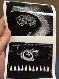 First Ultrasound At 8 Weeks 5 Days Last Week With Fetal Heart Rate Of 175bpm 2nd Babe And I May Or May Not Have Cried Babybumps