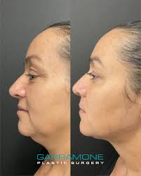 Ralph Garramone, Plastic Surgeon and Medi-Spa