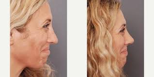 Charles East, MBBS, FRCS, Facial Plastic Surgeon