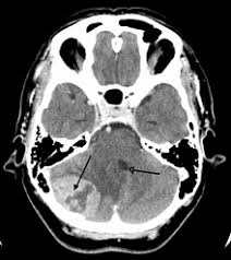 In addition to general symptoms, babies and toddlers with brain tumors also may experience: Brain Tumor Wikipedia