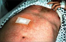 It is one of the. Cutaneous Involvement In Angioimmunoblastic T Cell Lymphoma Abstract Europe Pmc