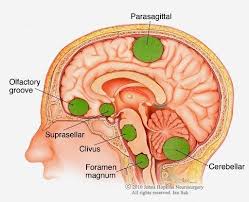 Pin On Brain Tumor