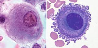 This paper aims to report a case of mesothelioma in a dog, obtained from the cytological analysis of pleural and abdominal fluid, which … Malignant Primary Mal P Mesothelioma Springerlink